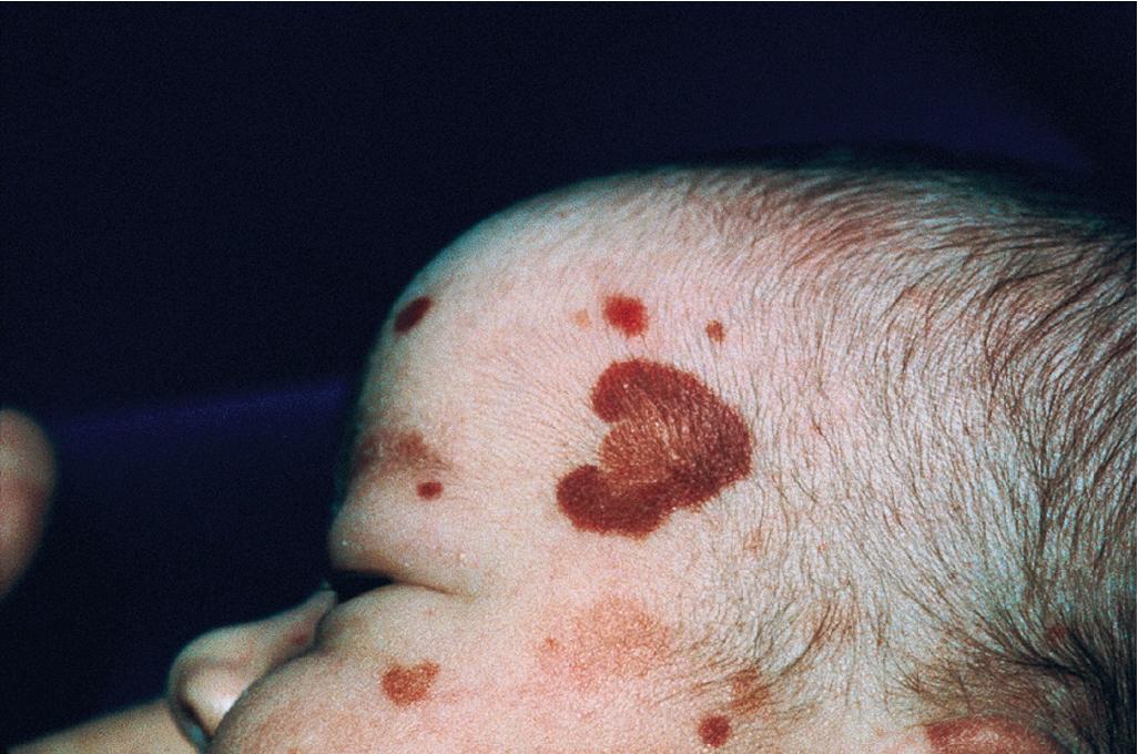 Fig. 21.10, Acute hemorrhagic edema of infancy. Medallion-like (“cockade”) purpura in a newborn girl with congenital onset of the disease.