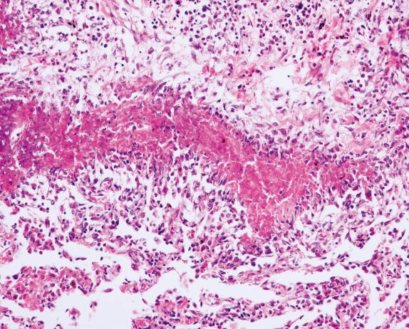 FIG. 8.11, Eosinophilic granulomatosis with polyangiitis (Churg-Strauss syndrome): allergic granuloma. Parenchymal granuloma with palisading histiocytes and necrotic center composed predominantly of necrotic eosinophils.