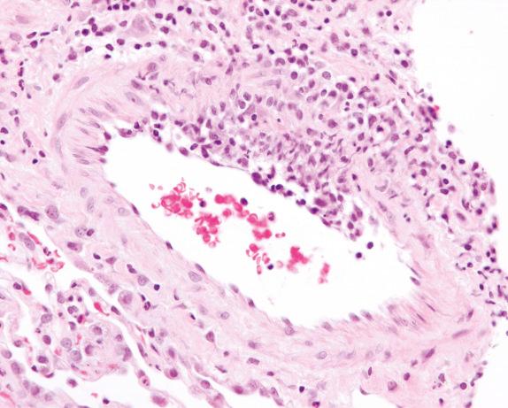 FIG. 8.2, Granulomatosis with polyangiitis (Wegener’s granulomatosis): vasculitis. There is focal subendothelial involvement of a small blood vessel by a mixed inflammatory infiltrate.