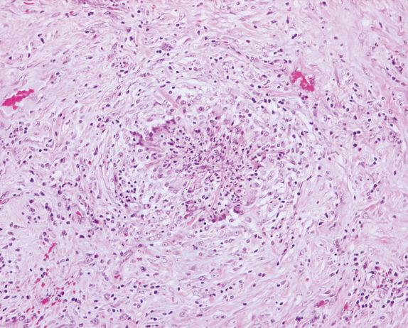 FIG. 8.4, Granulomatosis with polyangiitis (Wegener’s granulomatosis): granuloma. The granuloma shows palisading histiocytes with no distinct border separating it from the surrounding parenchyma. Note the presence of neutrophils in the necrotic center.