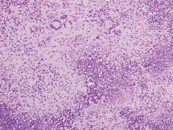 FIG. 8.6, Granulomatosis with polyangiitis (Wegener’s granulomatosis): inflammation and necrosis. This area shows palisading histiocytes and geographic necrosis that is irregular. Multinucleated giant cells are seen. The necrotic material is composed of cell debris and neutrophils.