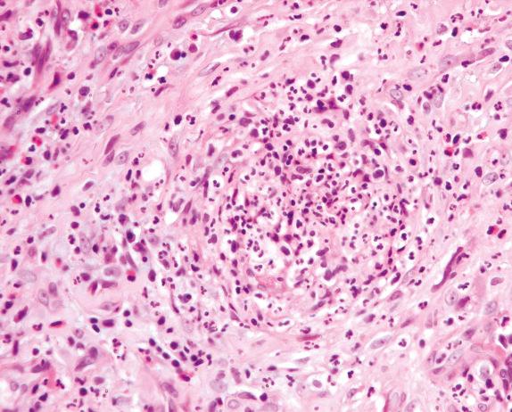 FIG. 8.7, Granulomatosis with polyangiitis (Wegener’s granulomatosis): microabscess. Note the small collection of neutrophils and eosinophils.