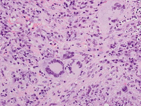 FIG. 8.8, Granulomatosis with polyangiitis (Wegener’s granulomatosis): multinucleated giant cells. These cells can be seen in association with the granulomatous inflammation or within the background inflammatory infiltrate. Note that some multinucleated giant cells can have a bizarre appearance (upper-right corner).