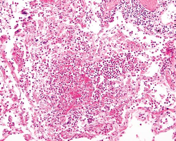 FIG. 8.10, Eosinophilic granulomatosis with polyangiitis (Churg-Strauss syndrome): eosinophilic pneumonia. Alveolar spaces are filled with an inflammatory infiltrate composed predominantly of eosinophils.
