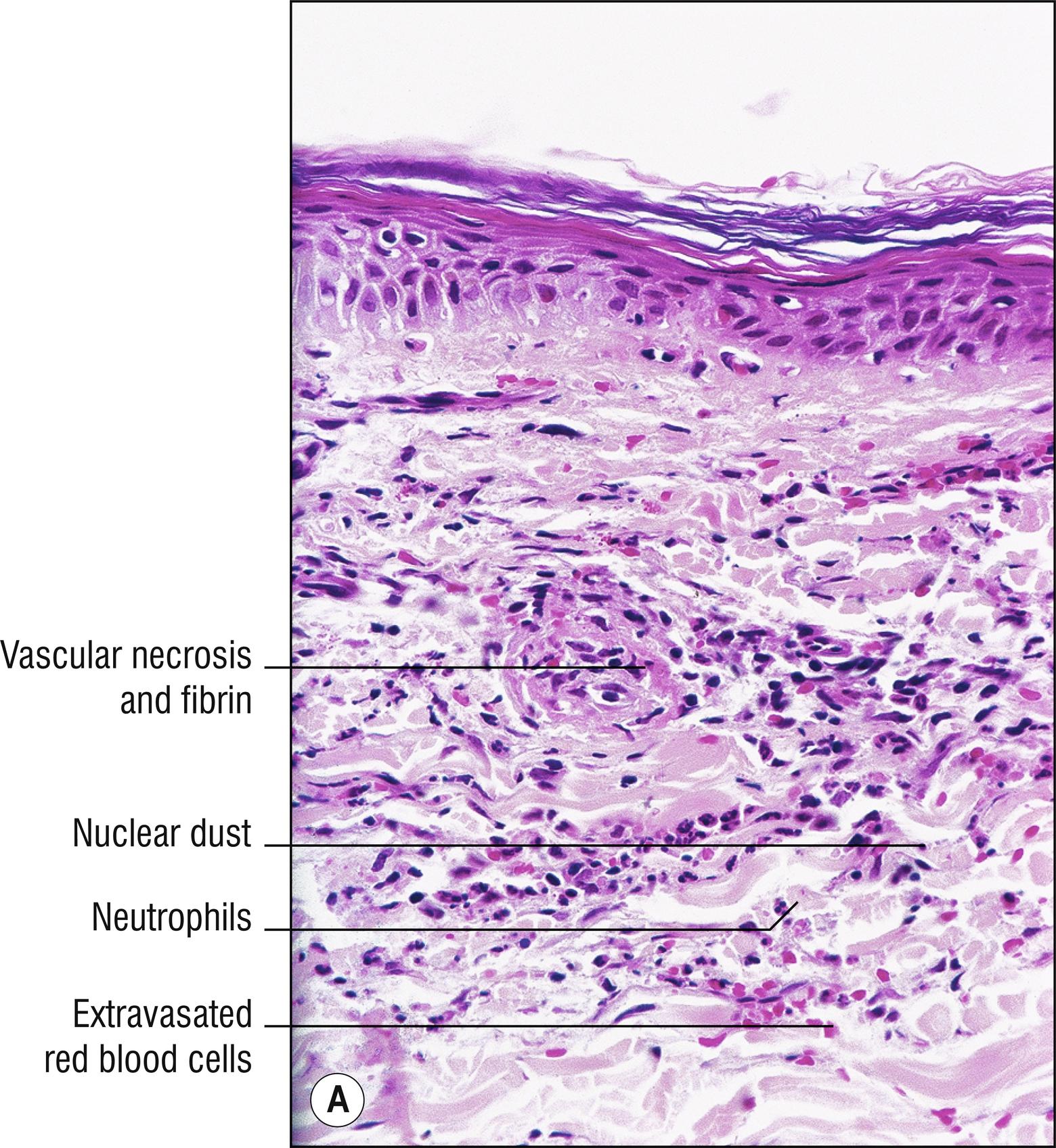 Fig. 4.1, A Leukocytoclastic vasculitis (low mag.).