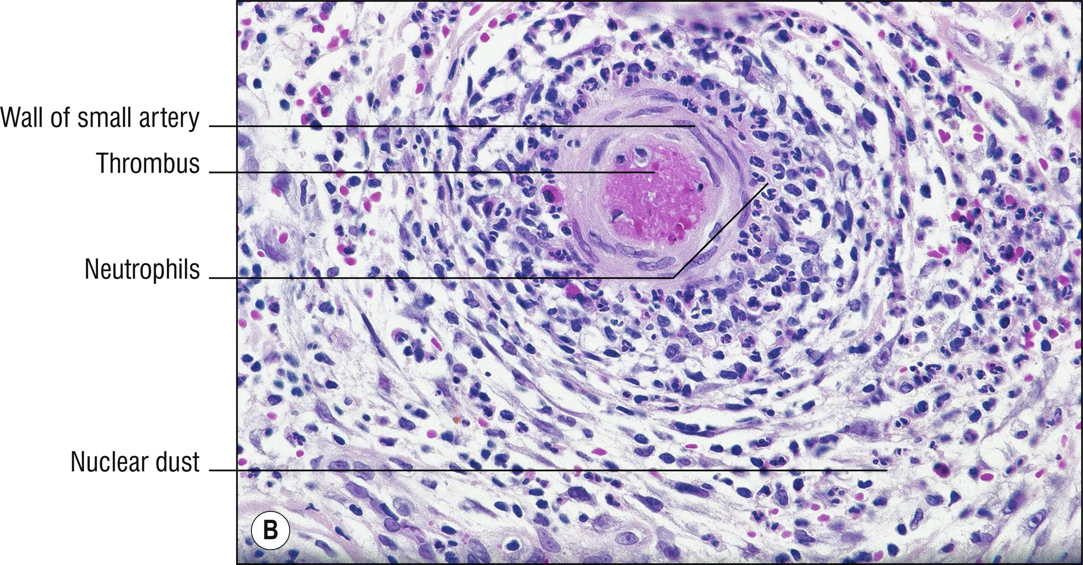 Fig. 4.4, B Polyarteritis nodosa (high mag.).