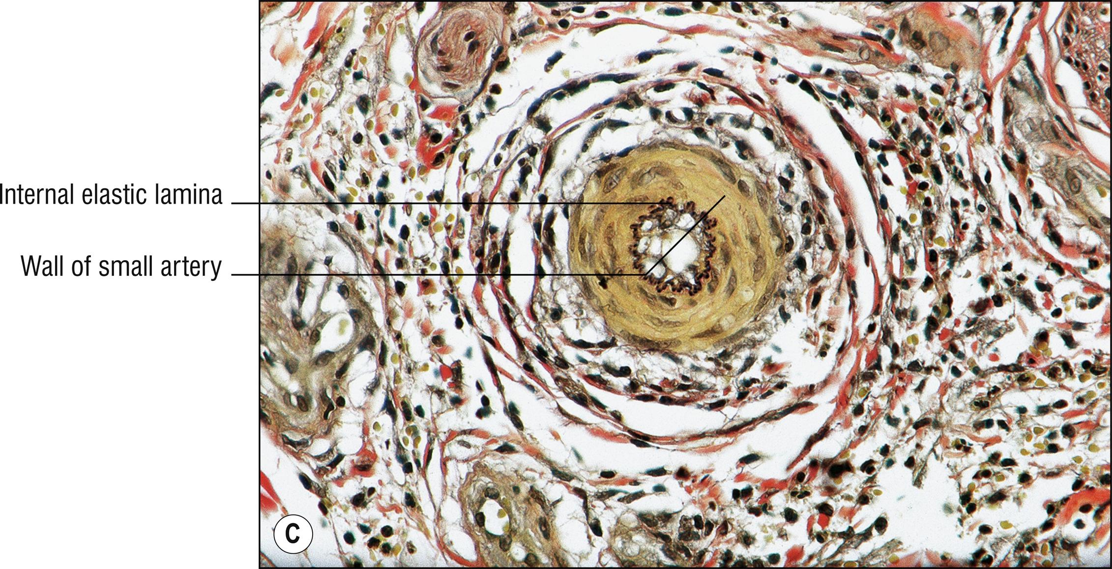 Fig. 4.4, C Polyarteritis nodosa (VVG stain demonstrating internal elastic lamina of artery).