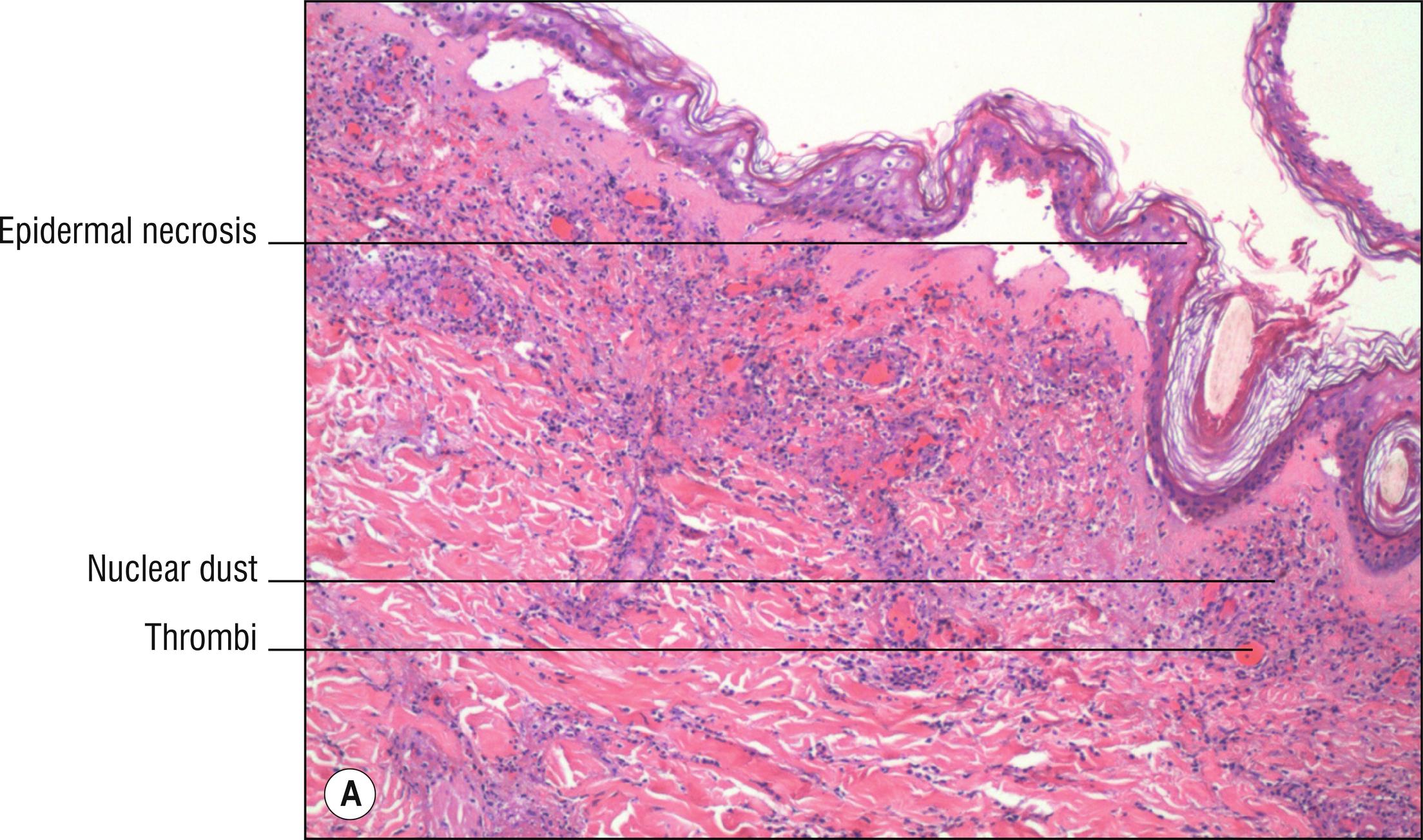 Fig. 4.6, A Wegener’s granulomatosis (low mag.).