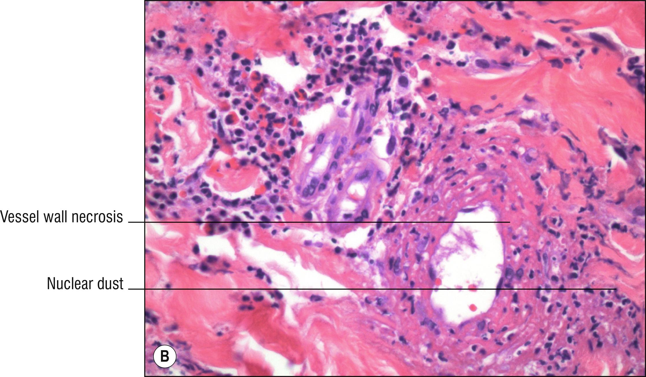 Fig. 4.6, B Wegener’s granulomatosis (high mag.).