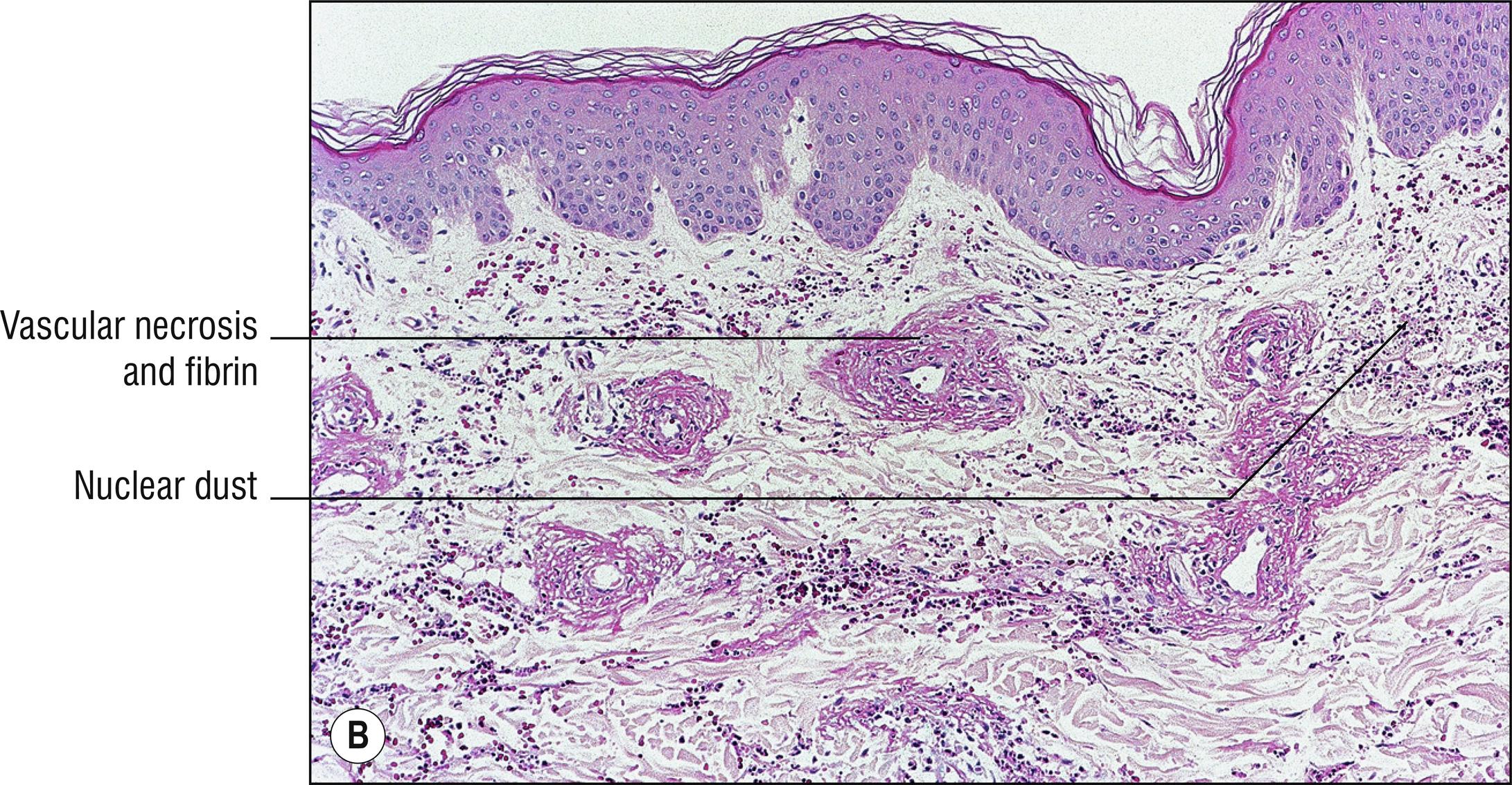 Fig. 4.1, B Leukocytoclastic vasculitis (high mag.).