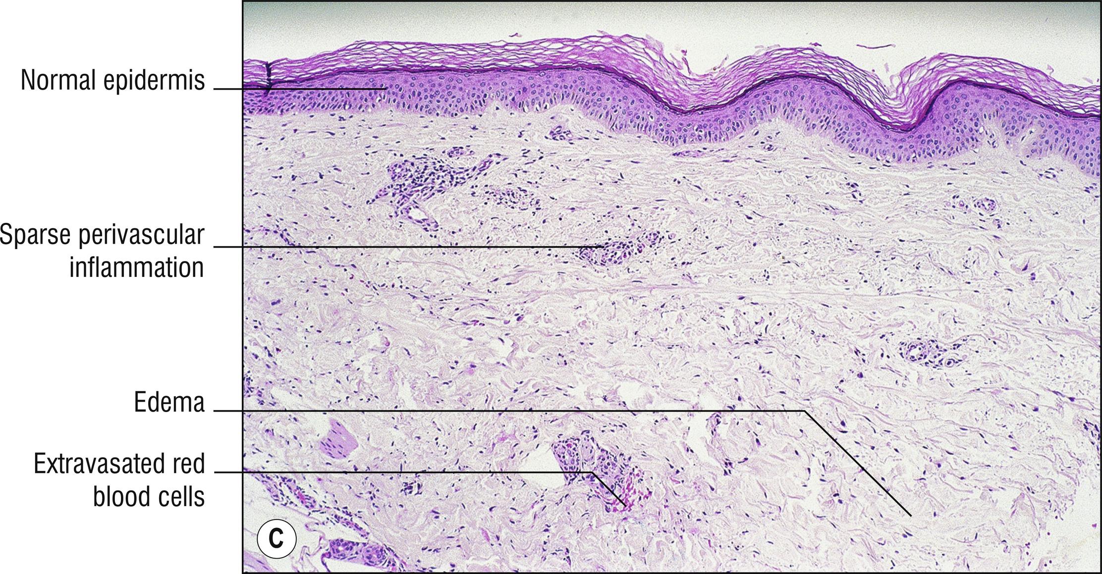 Fig. 4.1, C Urticarial vasculitis (low mag.).