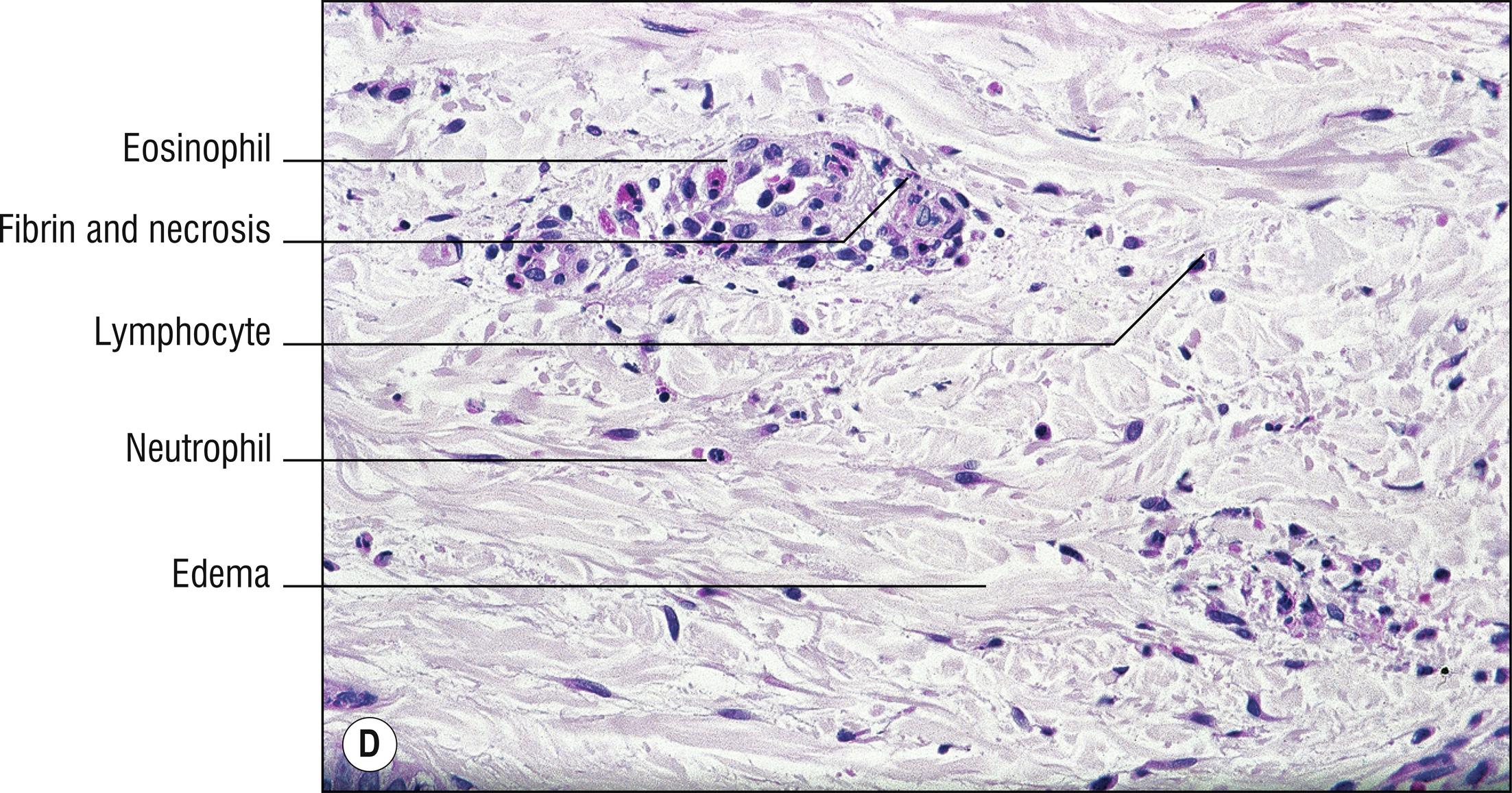 Fig. 4.1, D Urticarial vasculitis (high mag.).