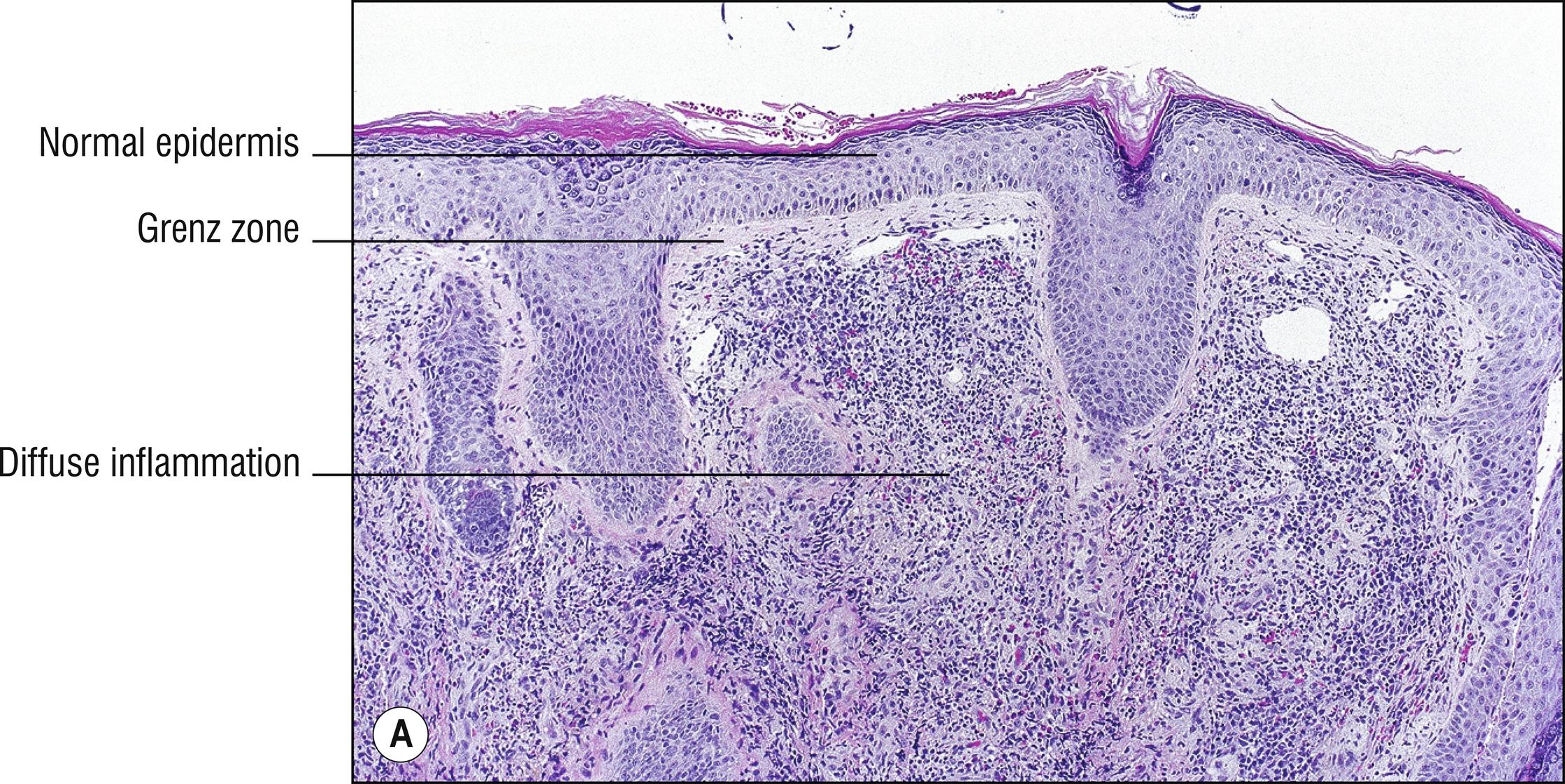 Fig. 4.2, A Granuloma faciale (low mag.).
