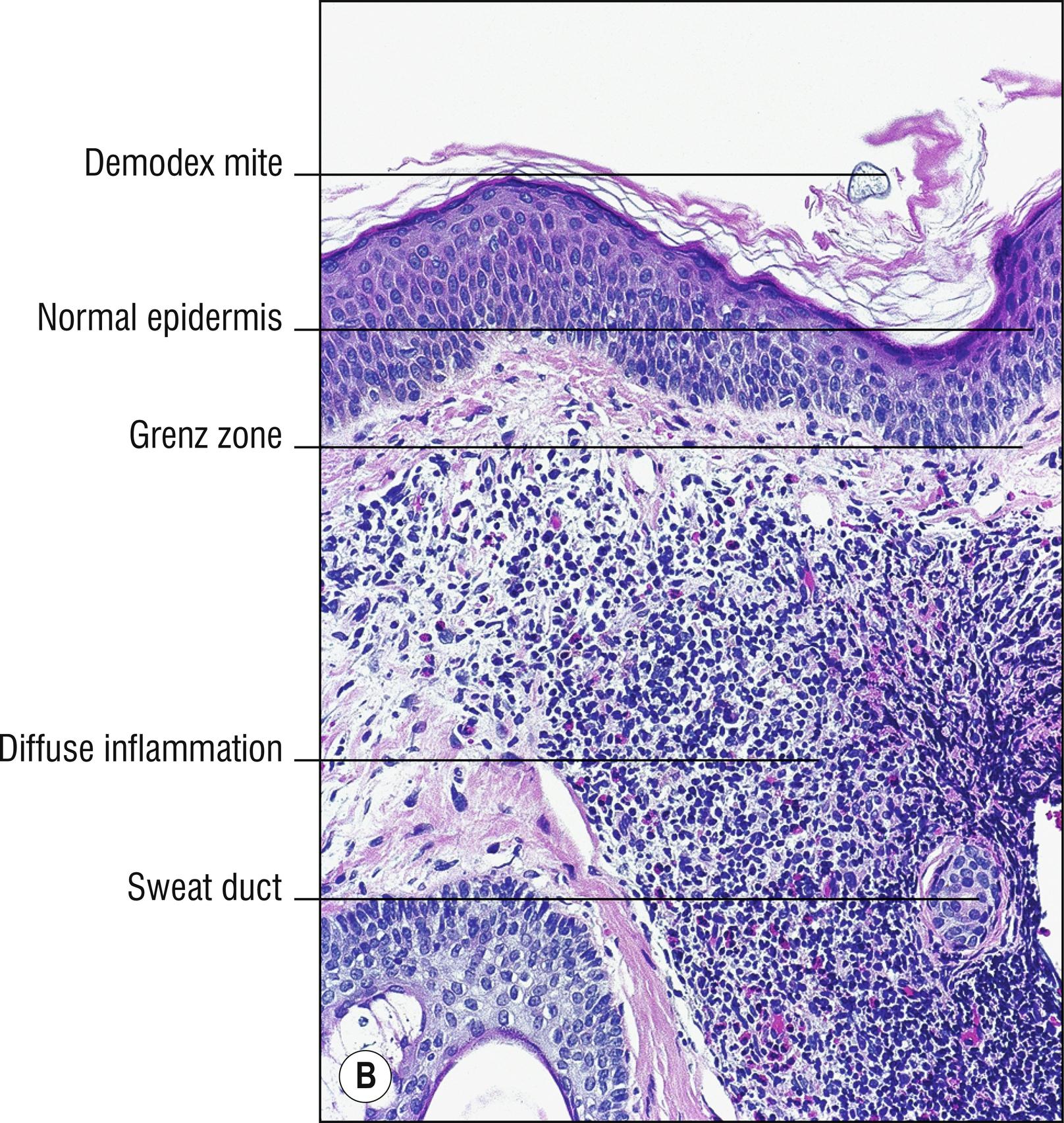 Fig. 4.2, B Granuloma faciale (medium mag.).