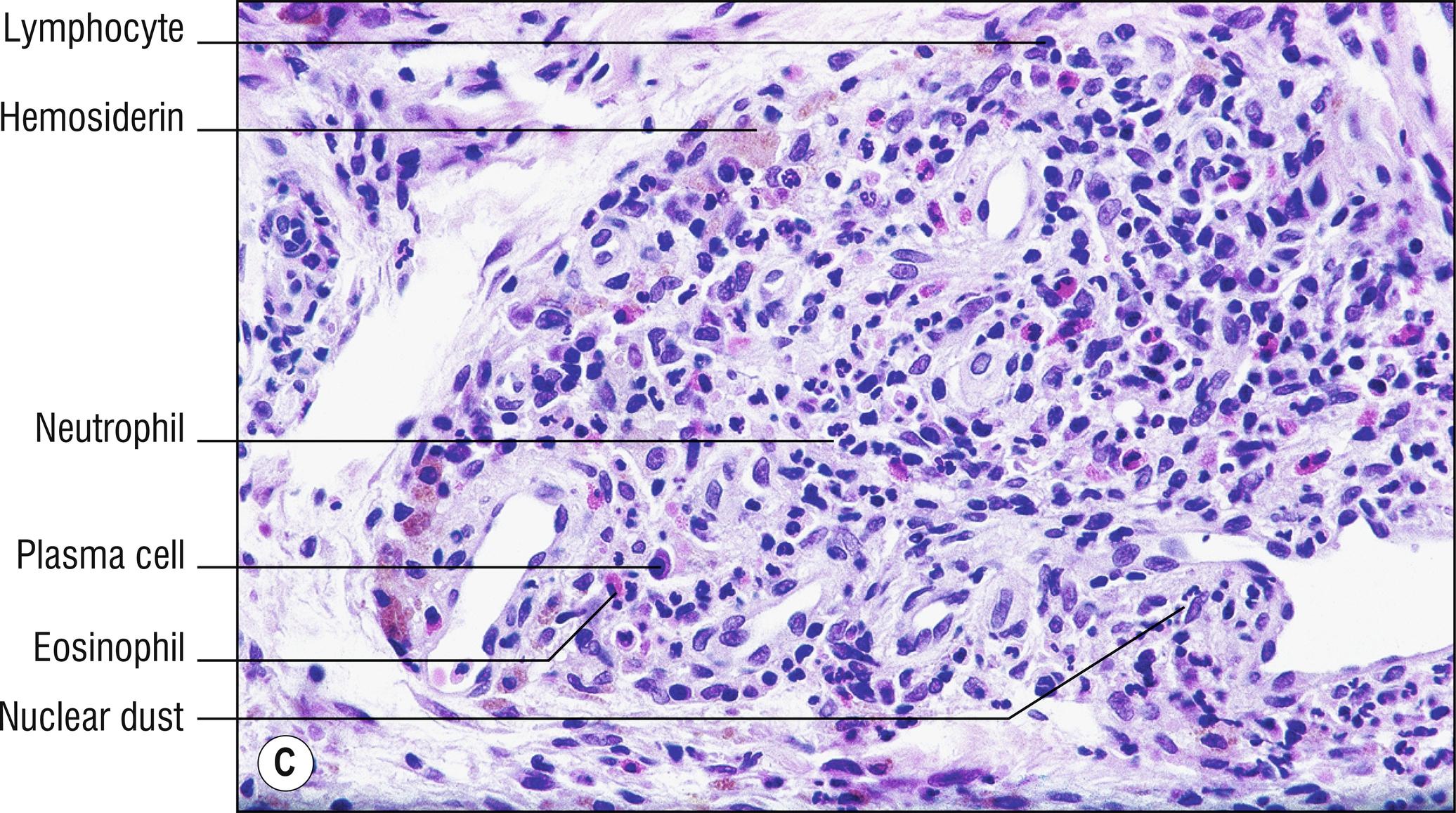 Fig. 4.2, C Granuloma faciale (high mag.).