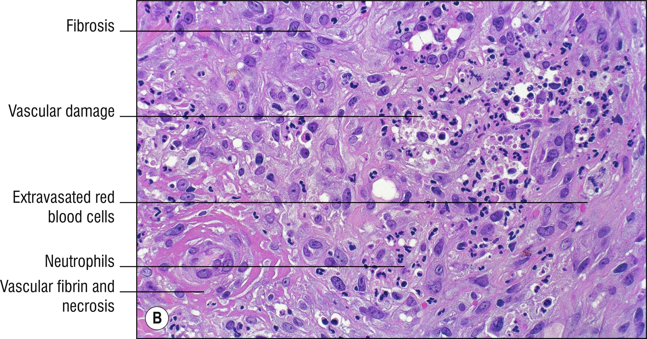 Fig. 4.3, B Erythema elevatum diutinum (high mag.).