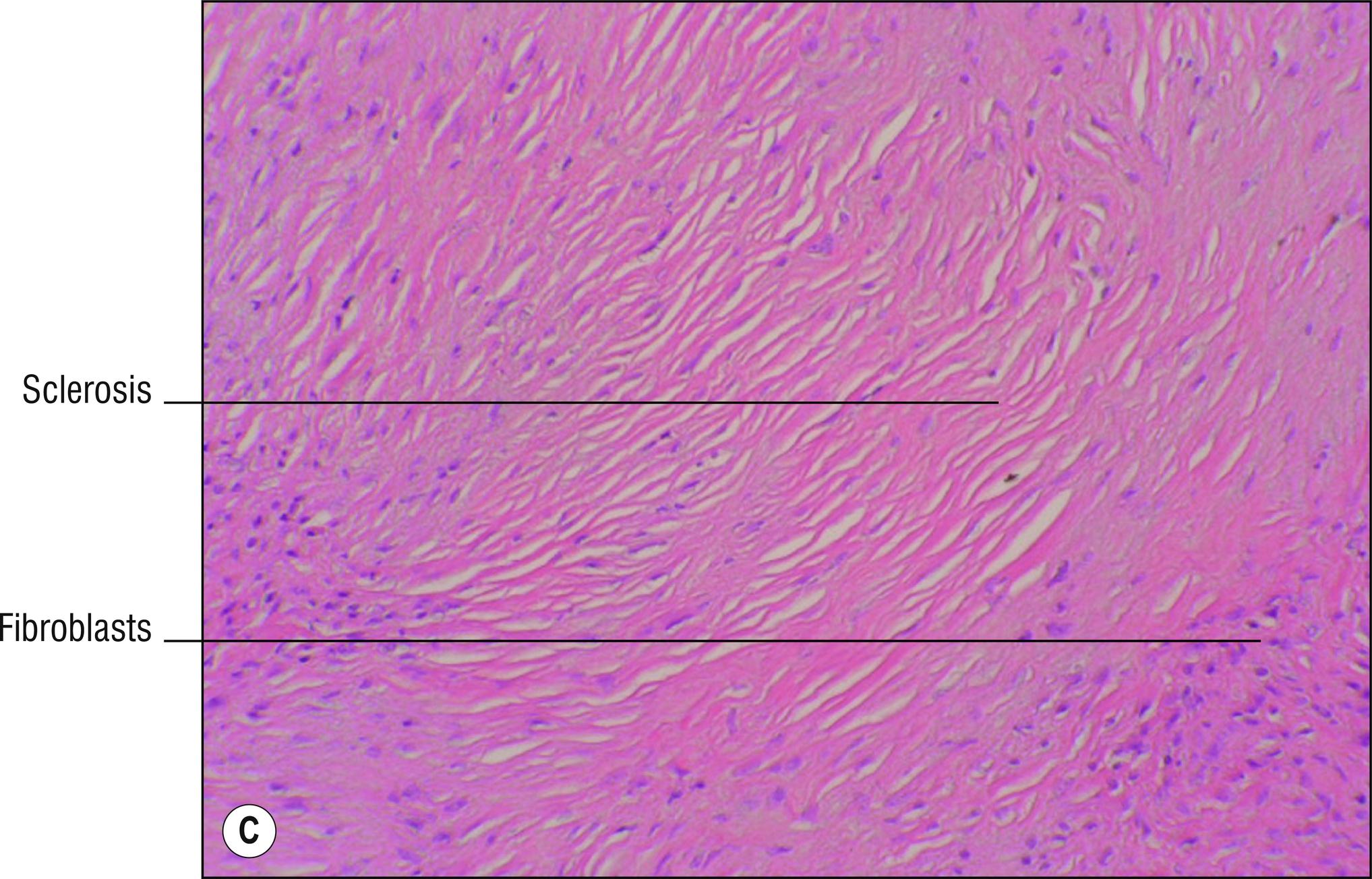 Fig. 4.3, C Erythema elevatum diutinum, late fibrotic nodule.