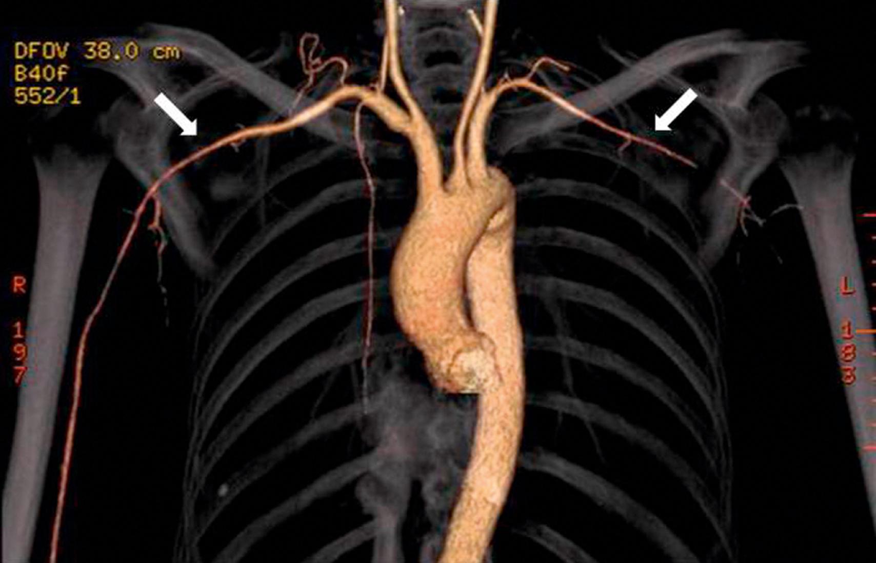 Figure 138.1, Computed tomography angiography with 3D reconstruction images reveals bilateral subclavian, axillary, and proximal brachial artery stenoses in a patient with giant cell arteritis. Moderate narrowing of both proximal common carotid arteries is also noted.