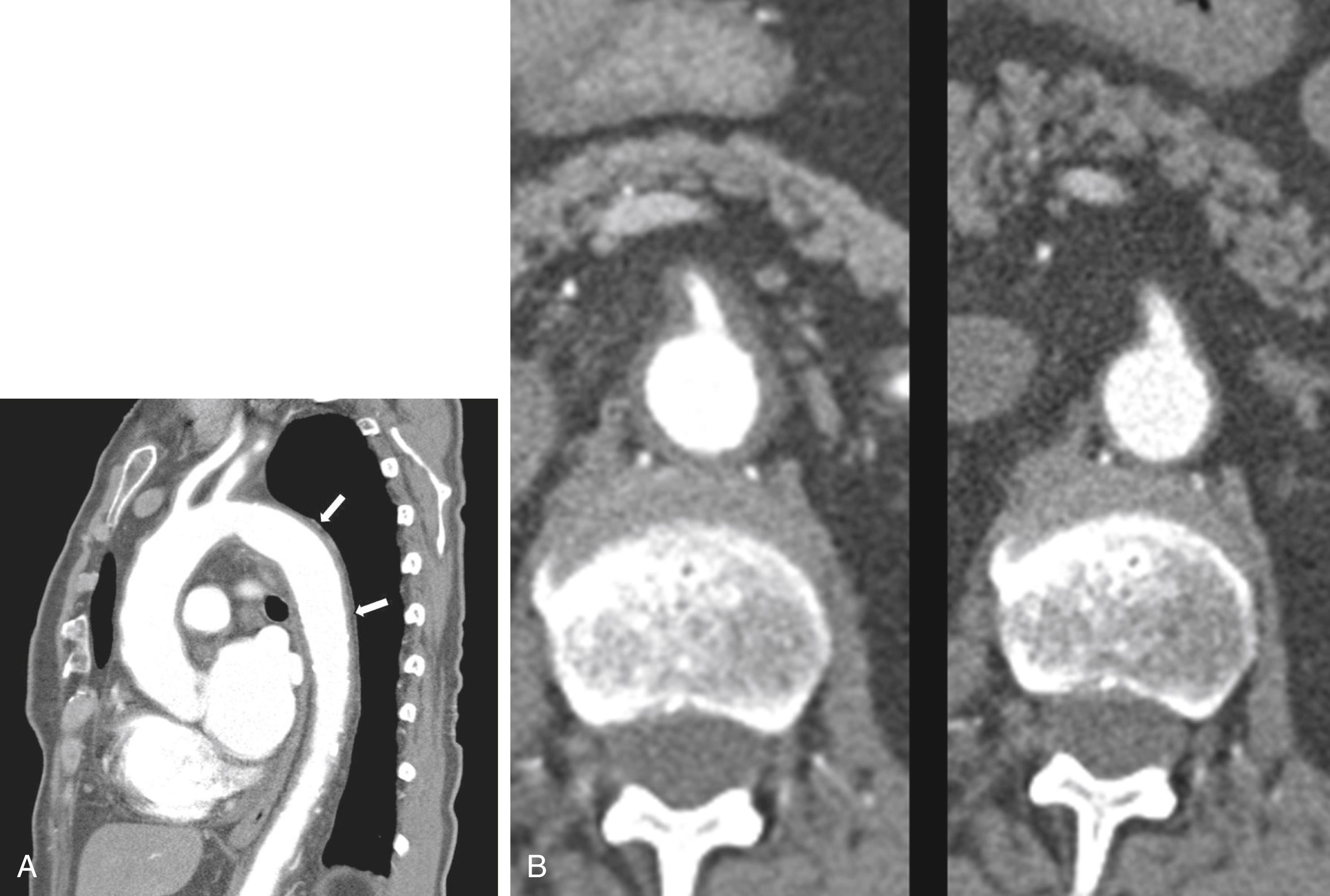 Figure 138.2, Computed Tomography Angiogram of a Patient with Giant Cell Arteritis and Involvement of the Aorta.