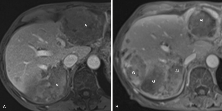 FIG 70-2, A, Prior to embolization therapy, there were two hepatic tumors (A). B, Months after embolization, the infarcted masses (AI) have reduced in size. Unfortunately, two new large masses have developed (G), fueled by glycolysis.