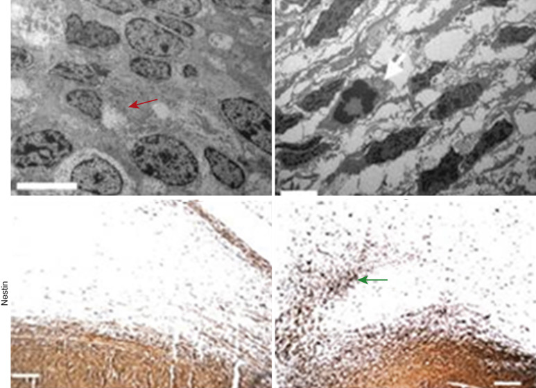 FIG 70-3, Top left, Before anti-VEGF therapy, cancer cells are pleomorphic with mitochondria. Top right, After treatment, cells become spindle shaped with few mitochondria. Bottom left, There is a sharp interface between glioblastoma and normal brain tissue. Bottom right, Following anti-VEGF treatment, cells become glycolytic and therefore motile and invasive. The arrow shows the “tumor wave” invading normal brain.