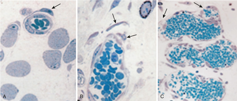 FIG 70-4, A, Host veins dilate and develop thin walls. B, After continued development, the veins proliferate into “mother” veins. C, The mother veins then subdivide into other veins.