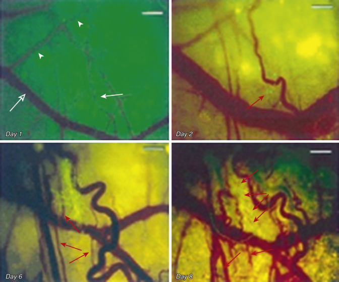 FIG 70-5, Transparent window shows the growth of tumor cells and vasculogenesis. Li stated that both of these processes (growth and angiogenesis) were visible at the 20- to 50-cell normoxic stage of tumor size. The explanation for angiogenesis before hypoxia can be understood by noting the cell motility on days 2 to 6. Such cell motility is due to hyaluronan, which is induced by lactate. This confirms that lactate is present prior to the development of hypoxia.