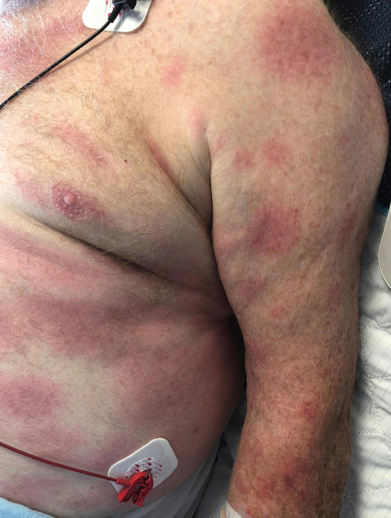 Fig. 15.1, Disseminated erythema migrans involving the trunk.