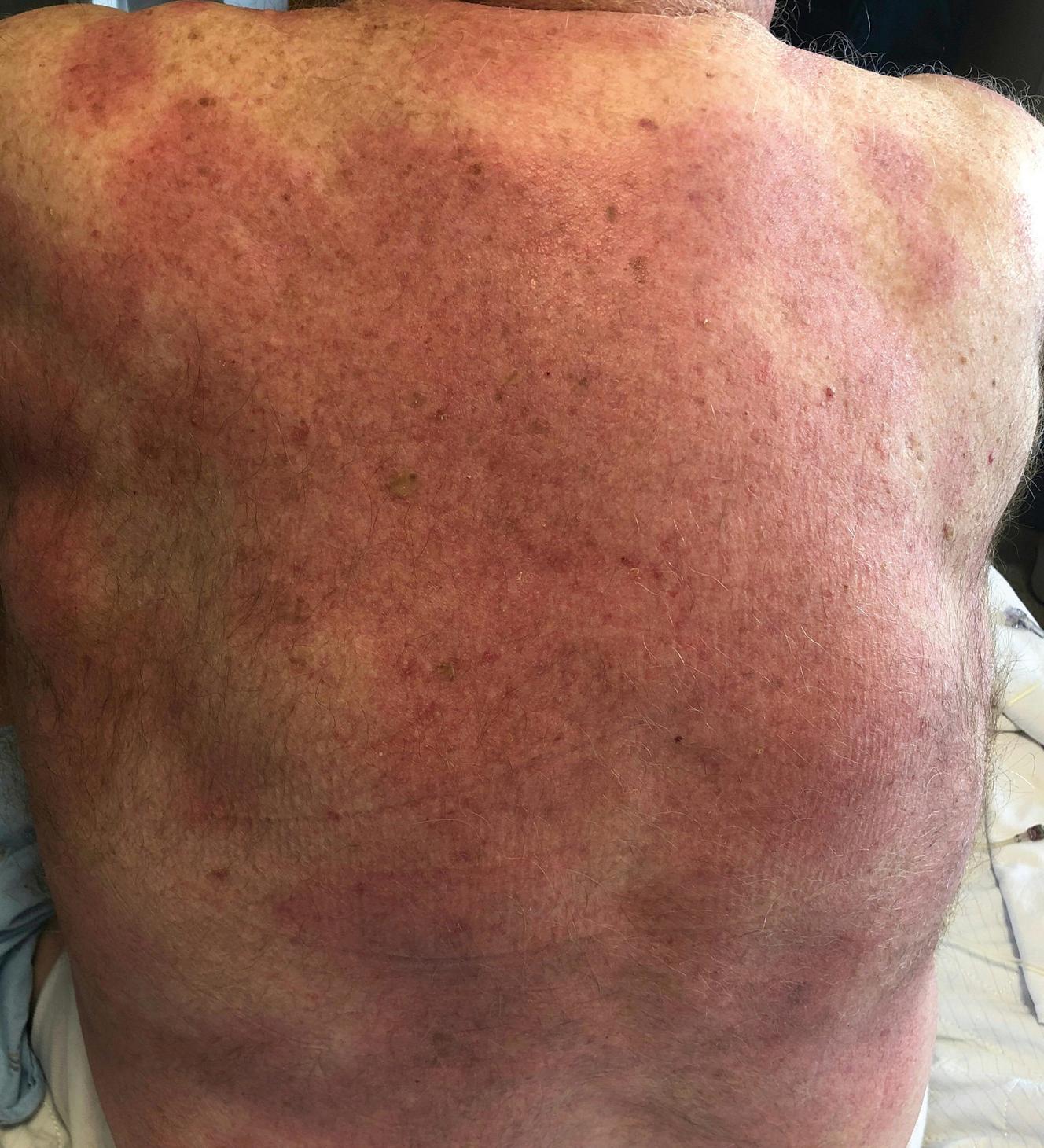 Fig. 15.2, Large area of erythema due to the confluence of multiple erythema migrans lesions.