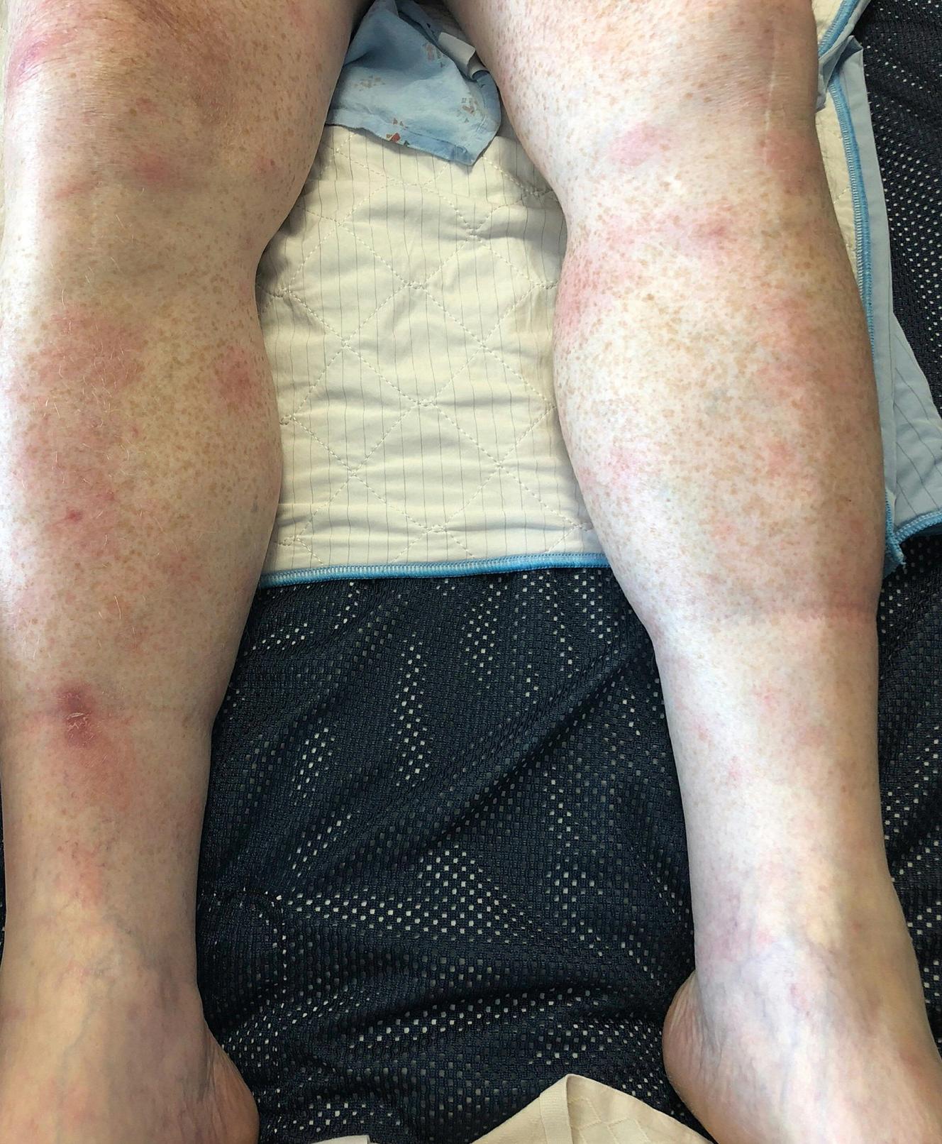 Fig. 15.3, Disseminated erythema migrans involving the legs.