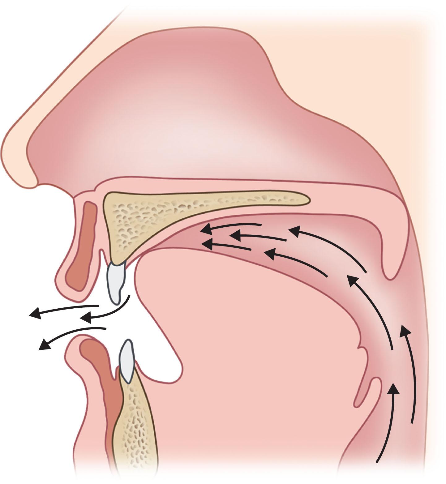 Figure 21.9.3, Lateral view of normal velopharyngeal closure for speech during production of an oral pressure consonant.