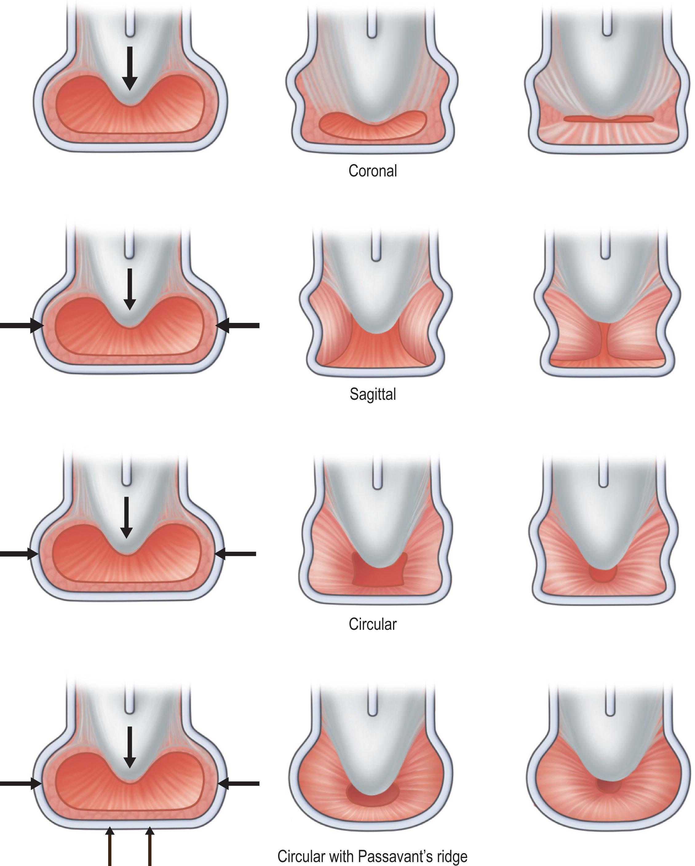 Figure 21.9.4, Types of velopharyngeal closure patterns.