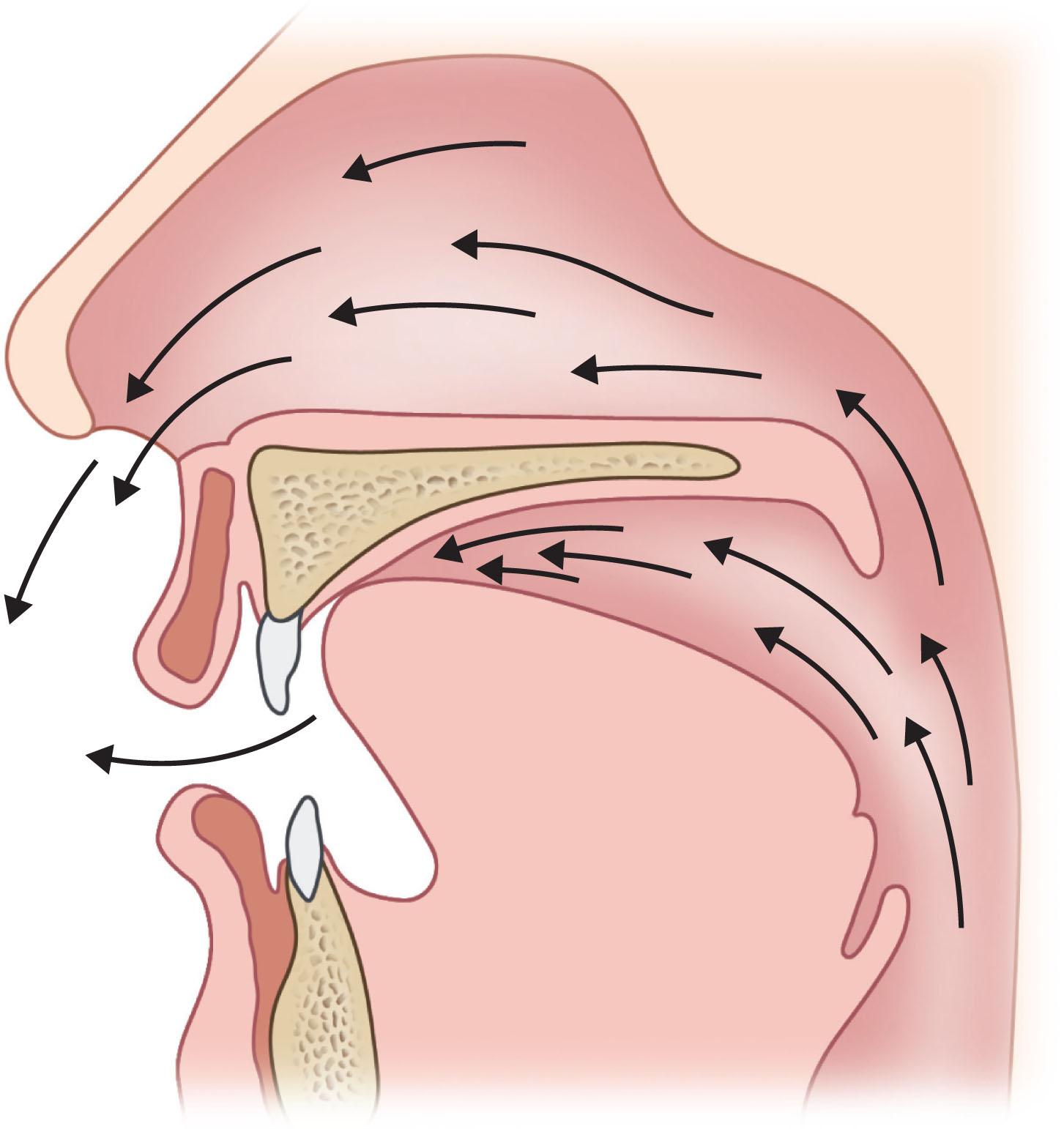 Figure 21.9.5, Lateral view of inadequate velopharyngeal closure for speech due to a short soft palate (velopharyngeal insufficiency). The arrows represent the escape of air, pressure, and acoustic energy through the nasal cavity during speech.