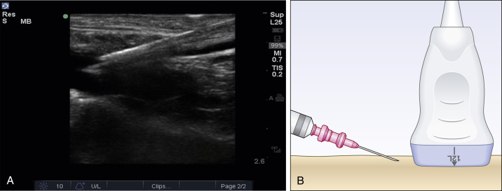 Fig. 30.4, (A) Central vein in the long axis with needle. (B) Needle in relation to ultrasound transducer for long-axis approach.
