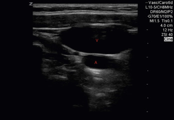 Fig. 30.5, Oblique axis of central vein ( V ) and artery ( A ).