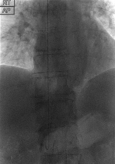 Fig. 86.1, Fluoroscopic Image Demonstrating the J -Wire Within the Inferior Vena Cava.