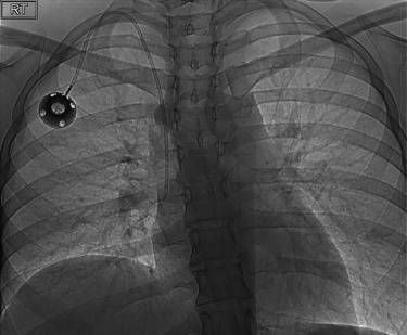 Fig. 86.6, Final Result Radiograph.