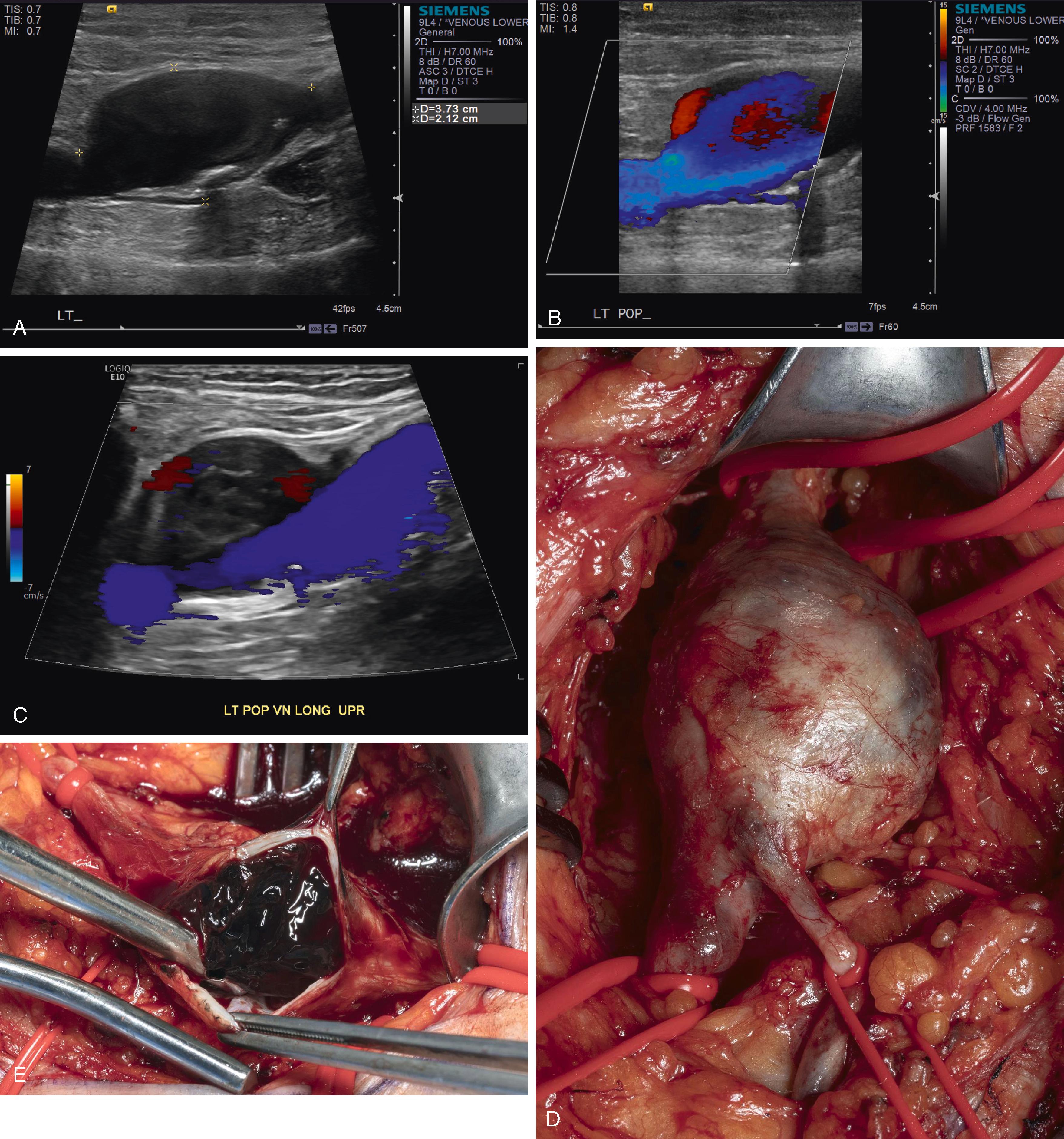 Figure 166.1, ( A ) Ultrasound image demonstrating turbulent flow in popliteal venous aneurysm. ( B ) Color flow image demonstrating turbulent flow in popliteal venous aneurysm. ( C ) Ultrasound image demonstrating thrombus in popliteal venous aneurysm. ( D ) Intraoperative photo of dissected popliteal venous aneurysm. (Photo: Nathan M. Pallace). ( E ) Intraoperative photo of luminal thrombus in popliteal venous aneurysm. (Photo: Nathan M. Pallace). (Used with permission of Mayo Foundation for Medical Education and Research, all rights reserved.)