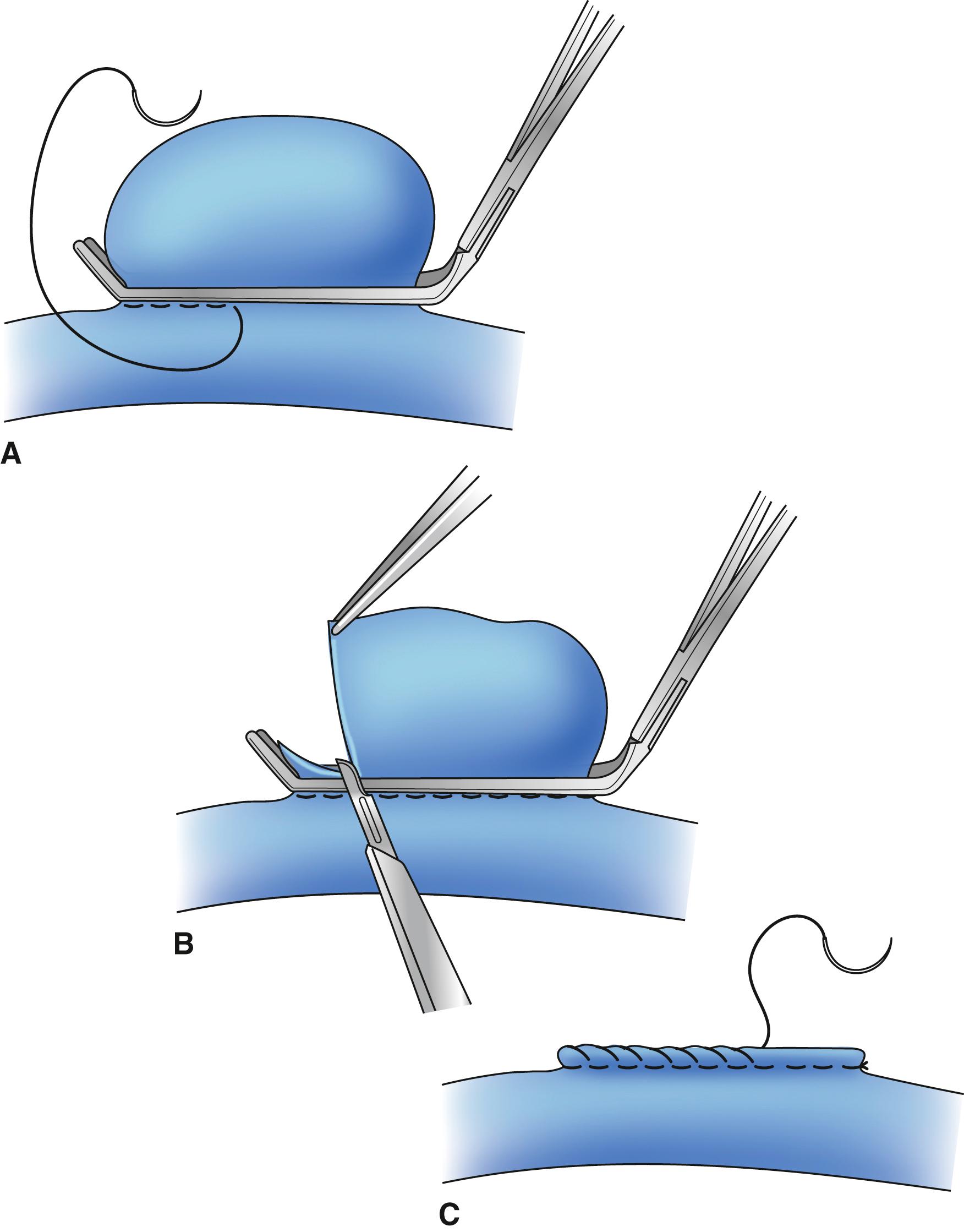 Figure 166.2, ( A ) Illustration of technique of tangential aneurysmectomy with lateral venorrhaphy. Clamp is placed at base of aneurysm without compromising lumen of popliteal vein. Vein walls are approximated by undersewing clamp with running horizontal mattress stitch. ( B ) Aneurysm is resected flush with vascular clamp. ( C ) Second, reinforcing running stitch is placed, approximating vein wall edges external to mattress suture.