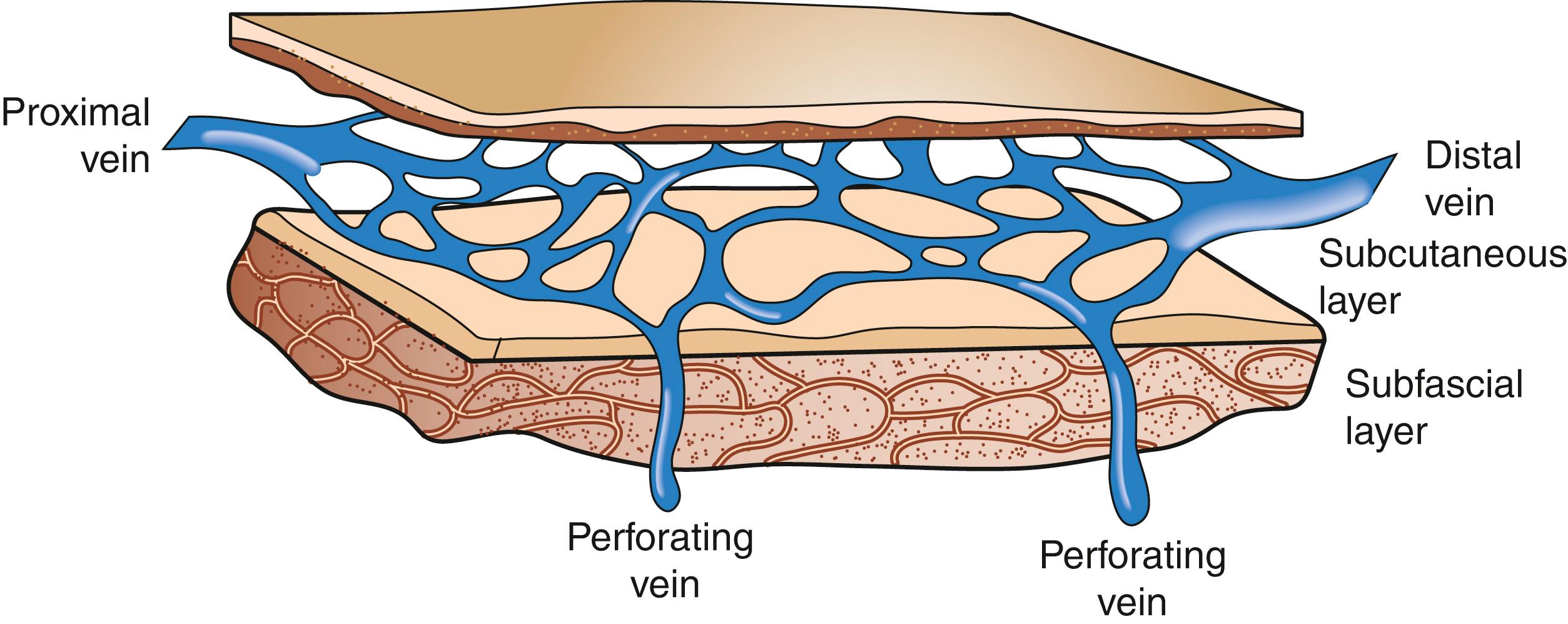 Fig. 65.4, Dilation of superficial venous tributaries caused by increased transmission of pressure by the perforating veins.