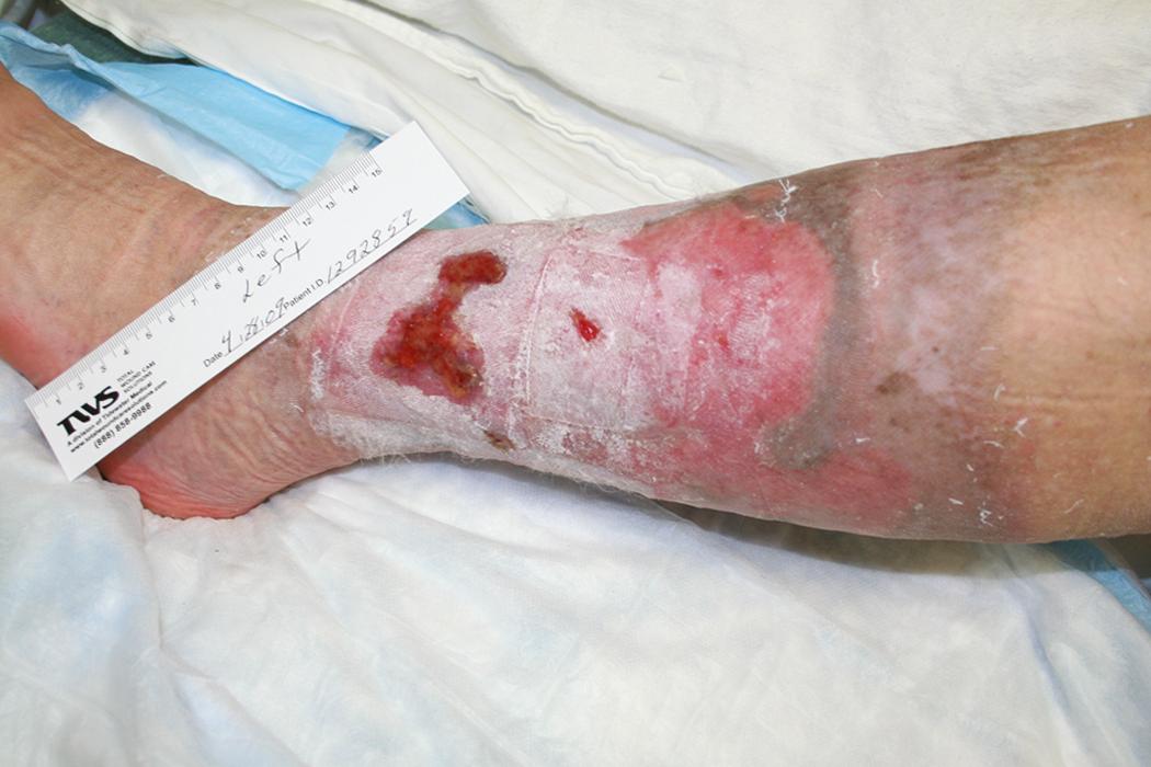 Fig. 65.7, Venous stasis ulcer.
