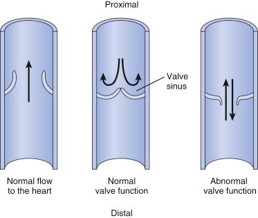 Fig. 45.1, Venous valves with schematic representation of normal and abnormal function.