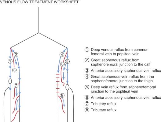 Fig. 45.4, Representative example of a preprocedure venous anatomy diagram used to simplify understanding of location and extent of superficial venous reflux in a given patient. The use of this type of tool can be incredibly useful in planning and executing a successful ablation.