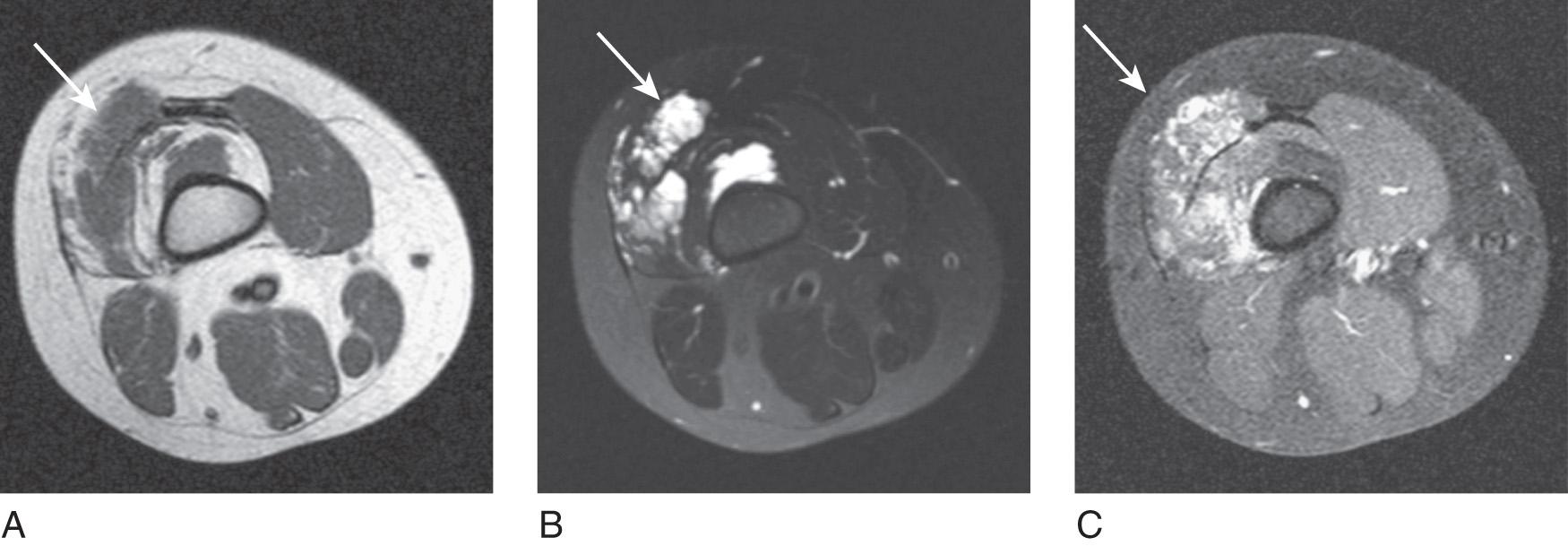 Fig. 25.1, A 10-year-old boy with focal thigh swelling and pain. Axial T1-weighted (A), T2-weighted (B), and T1-weighted after gadolinium (C) images demonstrating a T1 isointense and T2 hyperintense signal and enhancement after gadolinium in a venous malformation (arrow) in the lateral aspect of left lower extremity.