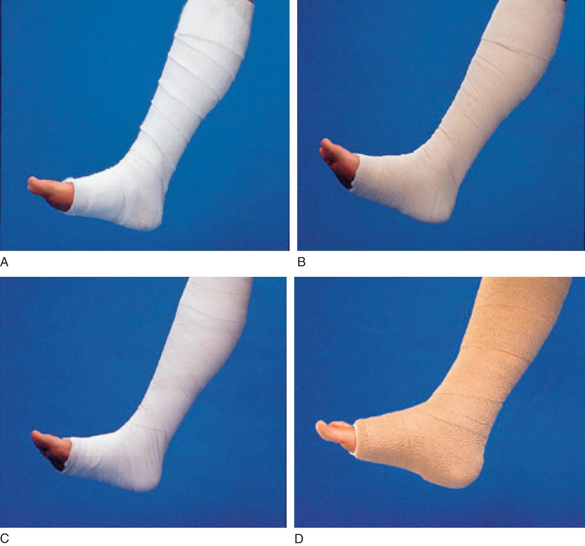 Fig. 20.1, Multilayer elastic compression. (A) Layer 1: orthopedic wool padding. (B) Layer 2: Light long-stretch elastic compression. (C) Layer 3: figure 8 wrapped elastic compression. (D) Layer 4: self-retaining elastic wrap.