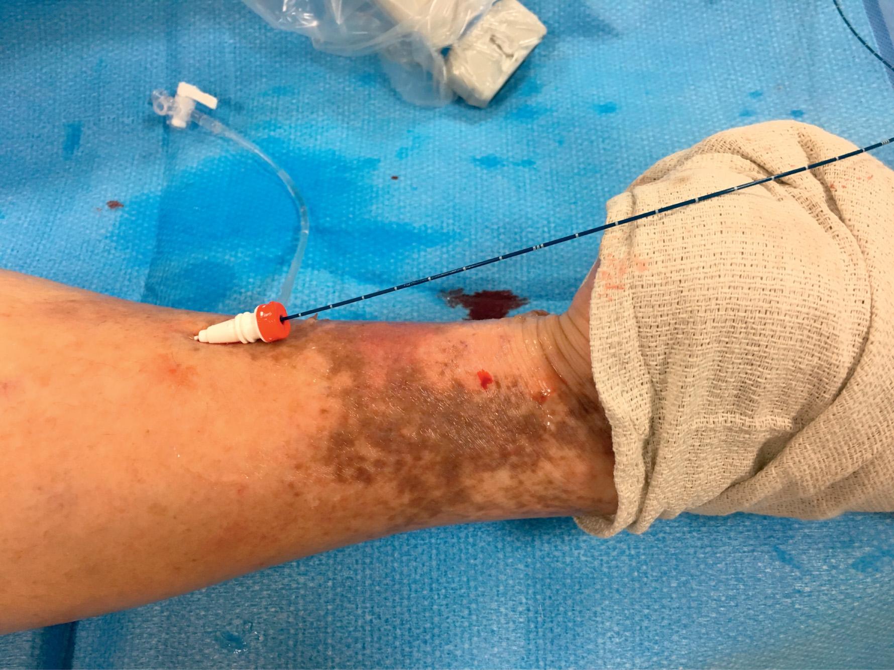 Fig. 20.2, Illustration of access of great saphenous vein in lower calf just above ulcer in medial ankle.