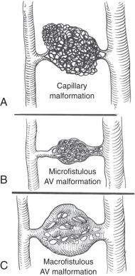 FIG 9.1, (A) Capillary malformation. (B) Microfistulous arteriovenous (AV) malformation. (C) Macrofistulous AV malformation.