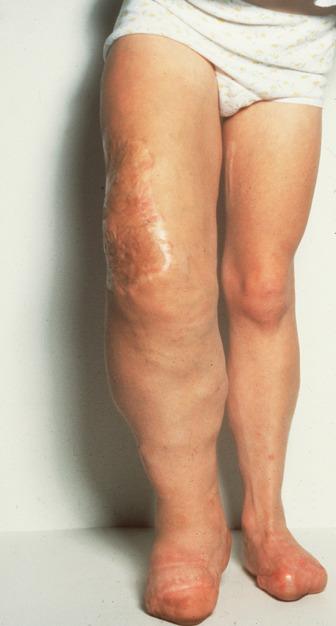 FIG 9.11, Bilateral leg involvement in Klippel-Trenaunay syndrome. Bilateral transmetatarsal amputations were needed because of digital anomalies.