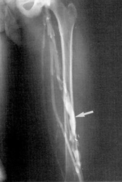 FIG 9.2, Persistent sciatic vein (arrow) in a 12-year-old girl. Surgical resection of the painful vein through a posterior approach resulted in an excellent clinical result at 7 years. The dilated vein contained no valves.