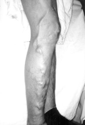 FIG 9.3, Persistent lateral embryonic veins in a 19-year-old male with Klippel-Trenaunay syndrome.